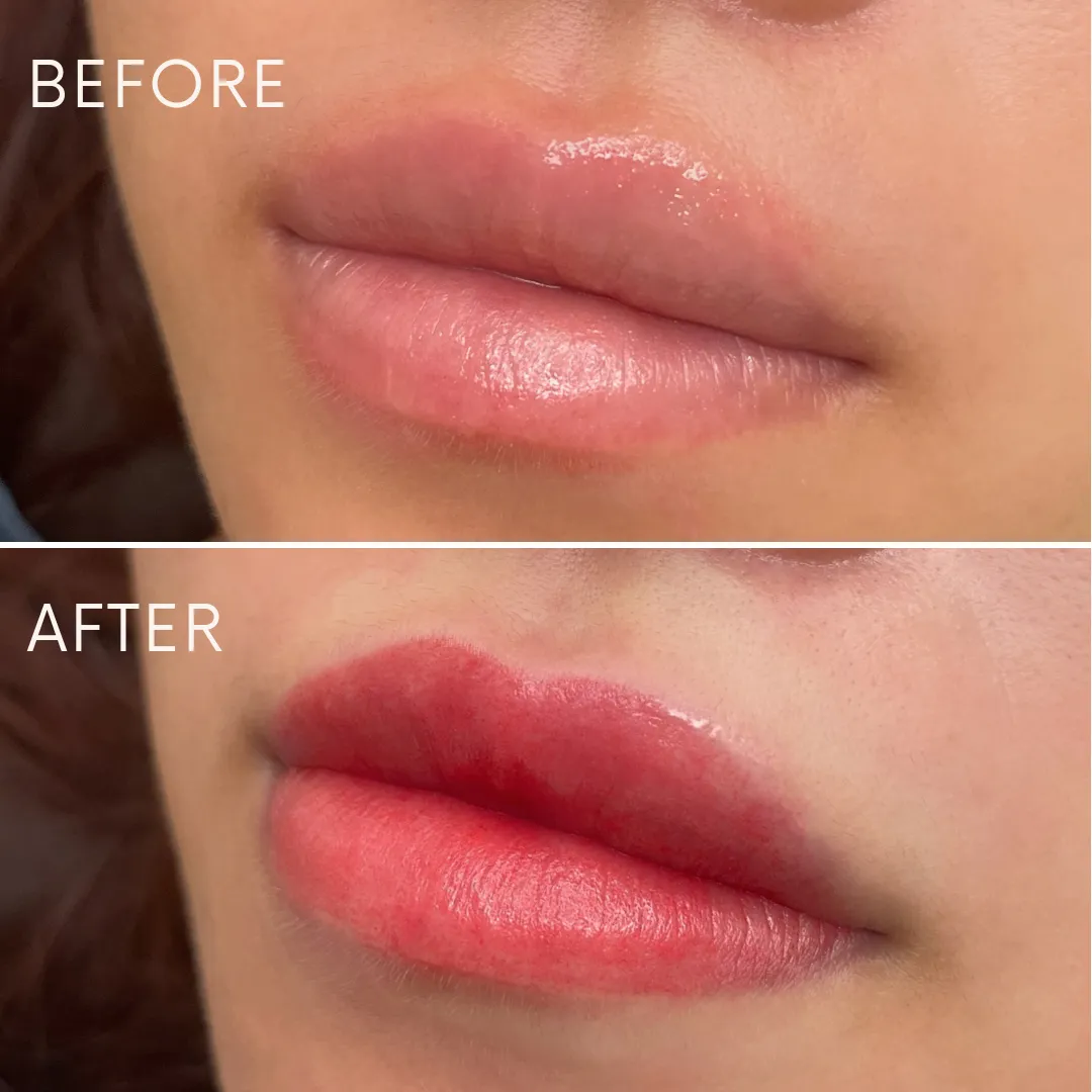 リップアートメイクの症例写真_05