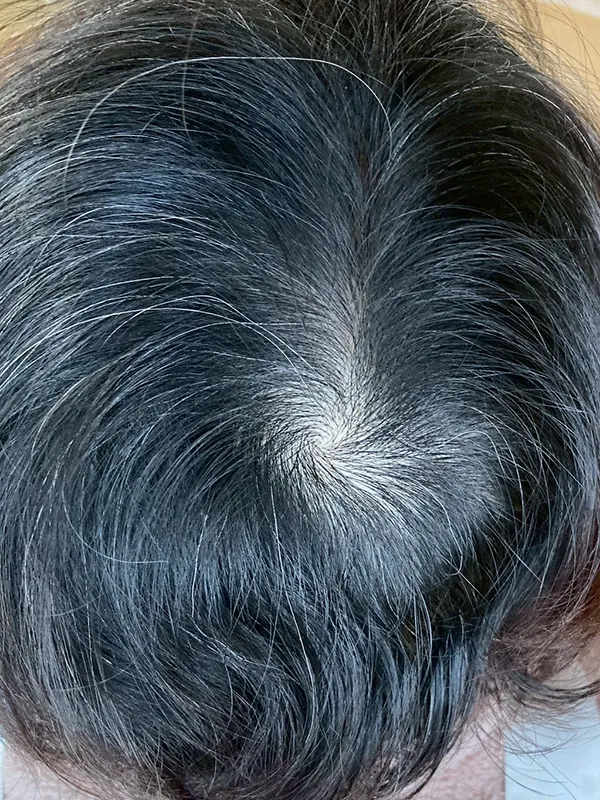 ヴェラルティスとルグゼバイブ併用 使用前