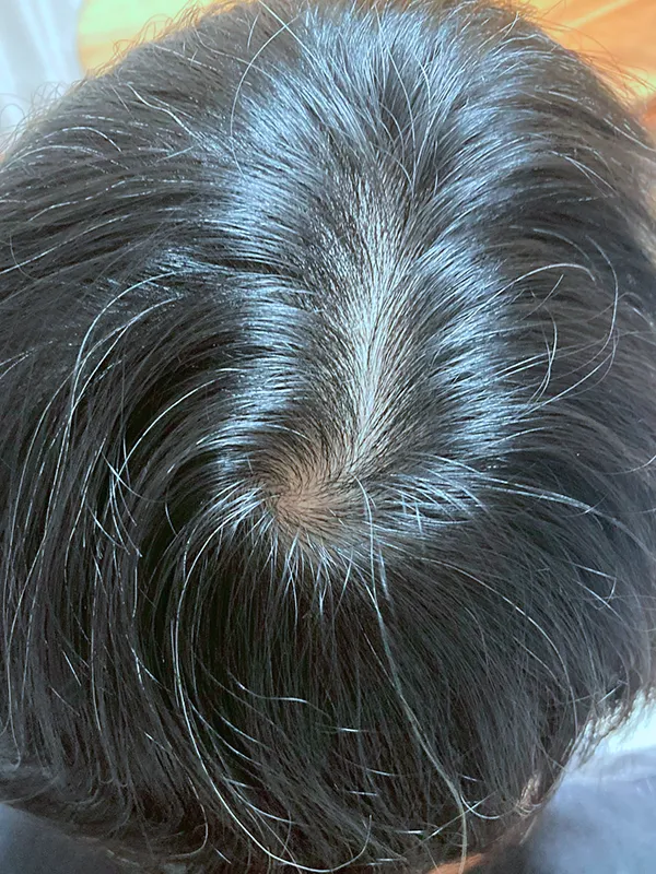 ヴェラルティスとルグゼバイブ併用 3ヶ月継続後