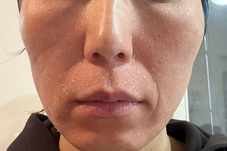 セラピューティックPHASE 1