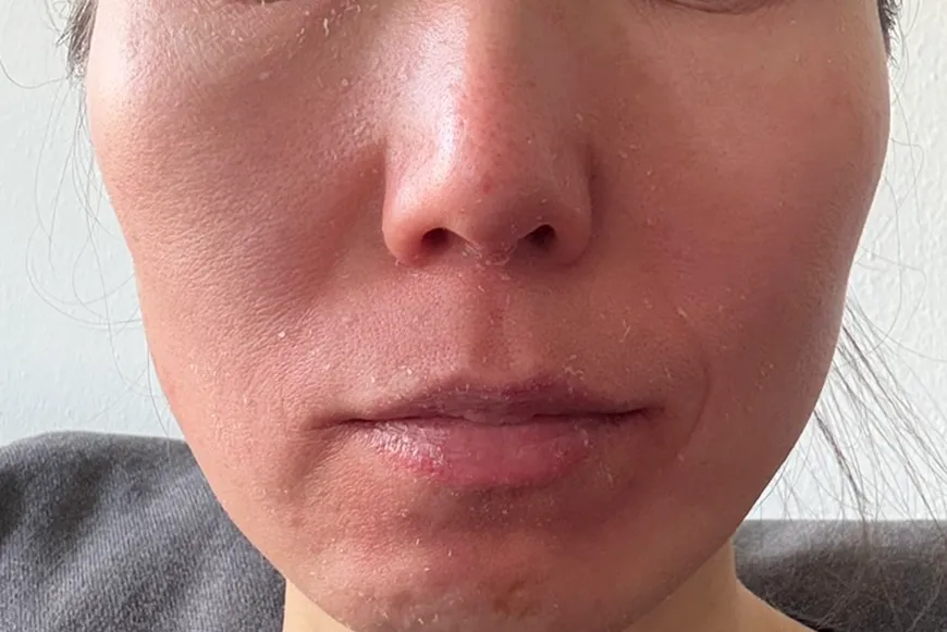 セラピューティックPHASE 3