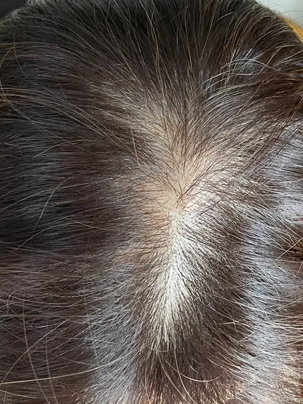 ルグゼバイブ使用前