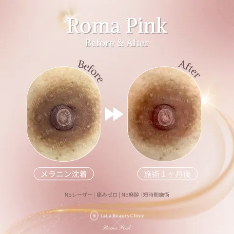 ローマピンク症例写真_02