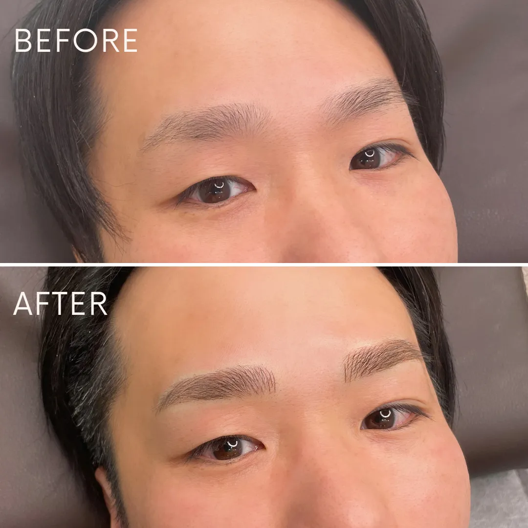 メンズアートメイクの症例_04