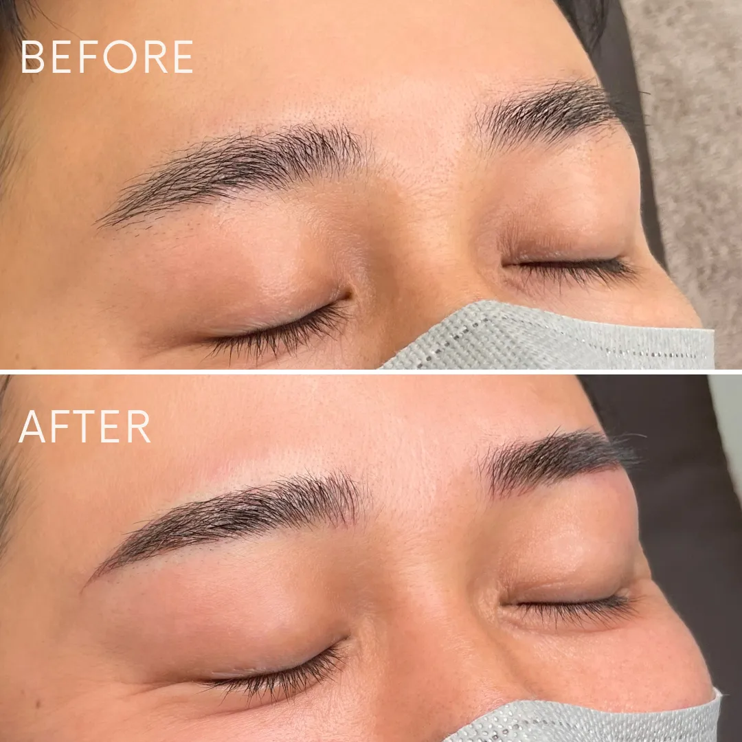 メンズアートメイクの症例_07